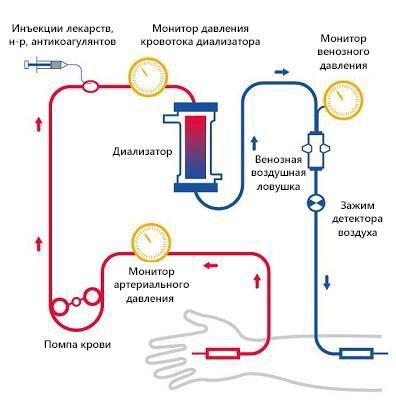 Гемодиализ: Кровь вытекает из тела и проходит через диализный аппарат. После того, как кровь очищается в диализаторе от вредных лишних веществ, она течет обратно в кровеносный сосуд.